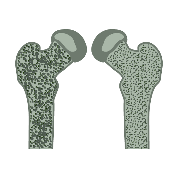 ENDOCRINE_DISORDERS_OSTEOPOROSIS